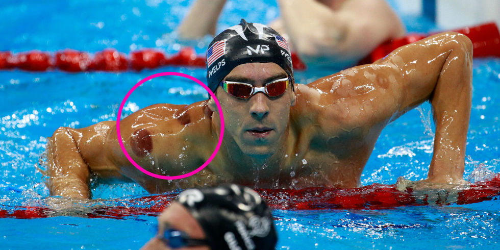 Mike Phelps Cupping